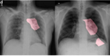 COVID-Net AI tool can help identify COVID-19 in Chest X-ray